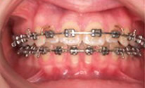 Dental Fixed Braces