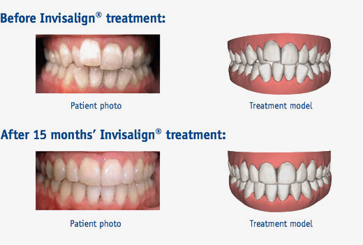 https://www.pinndental.co.uk/swf/library/invisalign/before_after.jpg